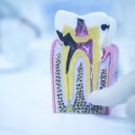 عوامل ایجاد پوسیدگی دندان